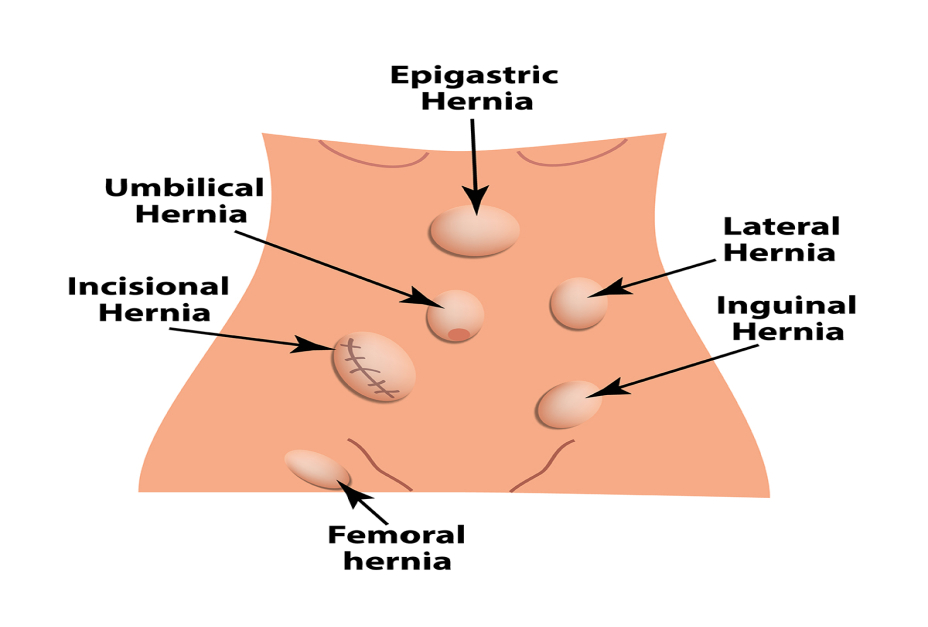 Types of Hernia