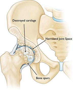 A visual representation of hip osteoarthritis and components