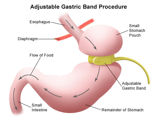 Adjustable Gastric Band Procedure