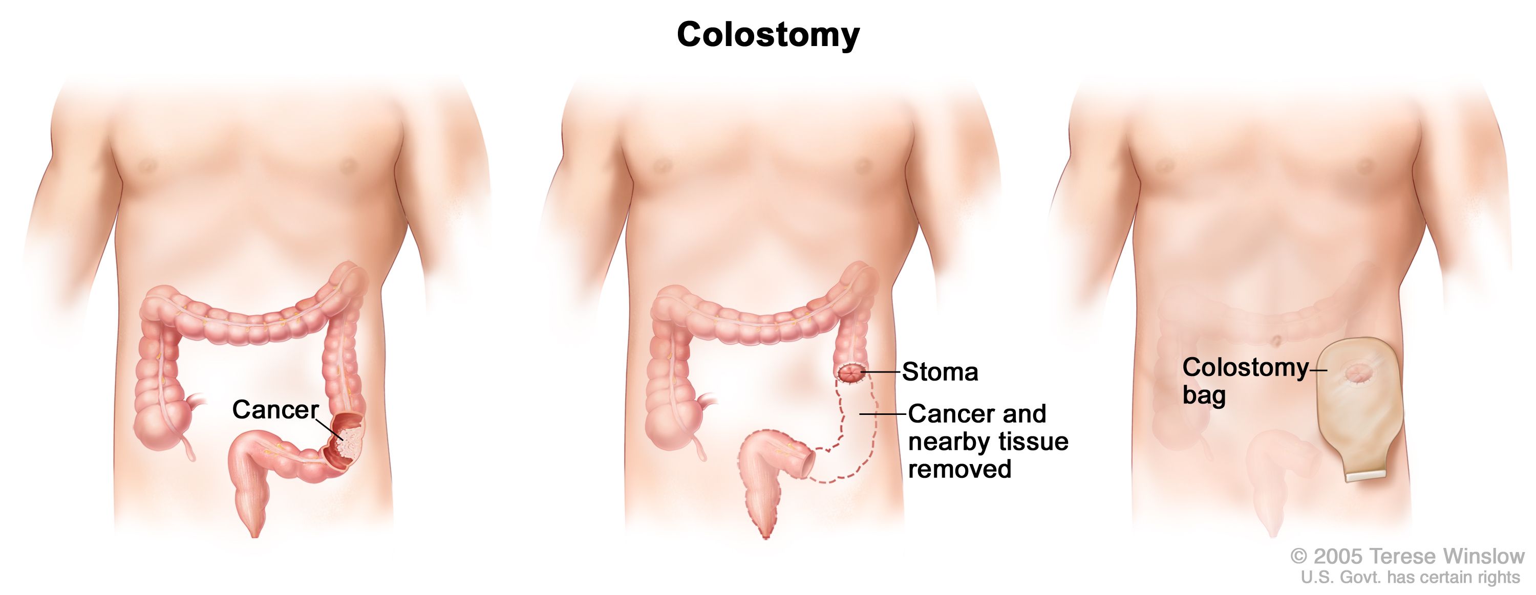 Colostomy