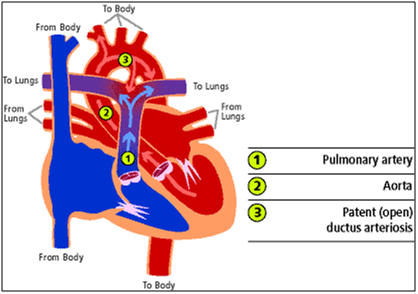 Patent Ductus Arteriosus (PDA)