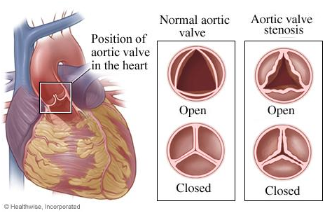 Aortic Valve in the Heart