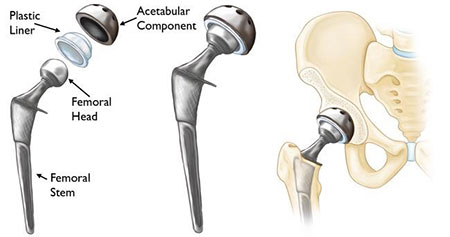  Total hip replacement components as they fit into the hip.