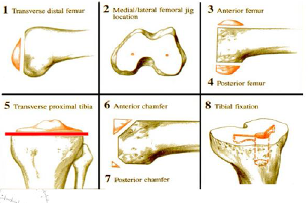 Overview of Femoral & tibial cuts 