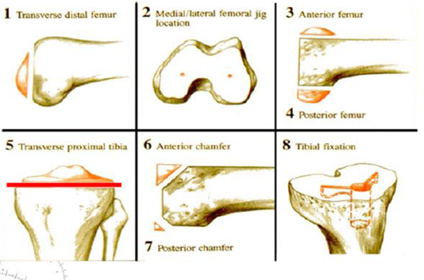 Overview of Femoral & tibial cuts - Total Knee Replacement Surgery