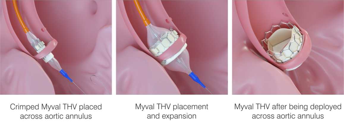 TAVR/ TAVI Procedure