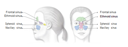 Sinusitis