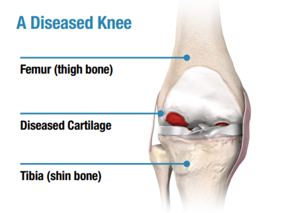 A guide on Diseased Knee & knee pain.