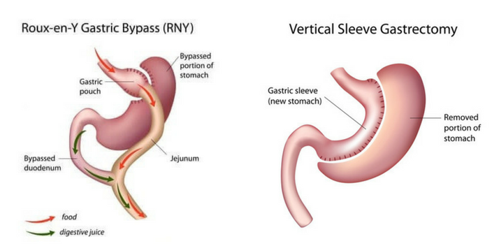 Roux-En-Y Gastric Bypass & Vertical Sleeve Gastrectomy