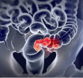 Gastrointestinal Tract Cancer