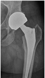 Total Hip Replacement - Hip surgery