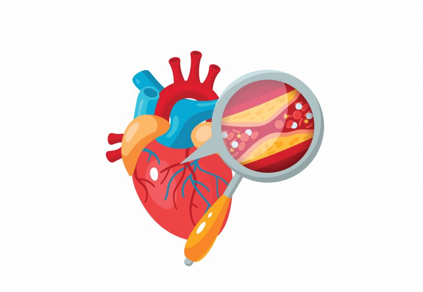 Coronary Angioplasty