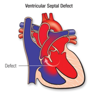 Ventricular Septal Defect (VSD)