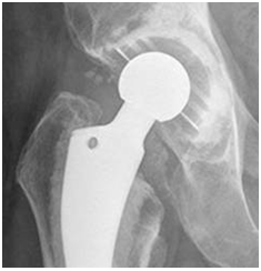 Partial Hip Replacement