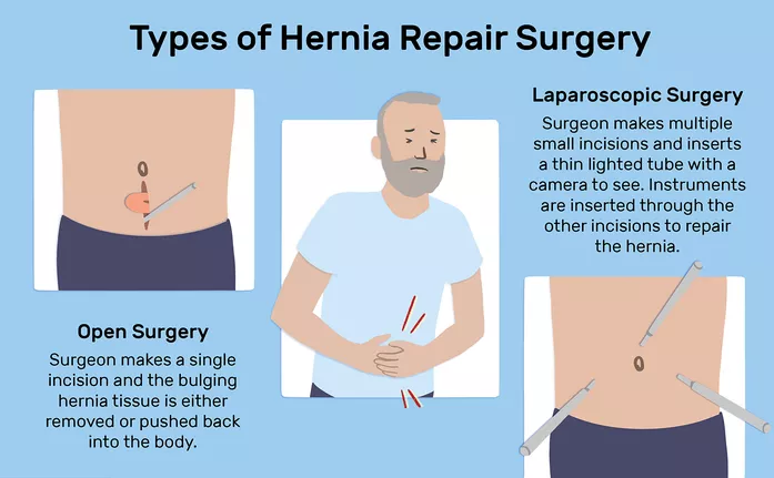 Types of Hernia Repair Surgery