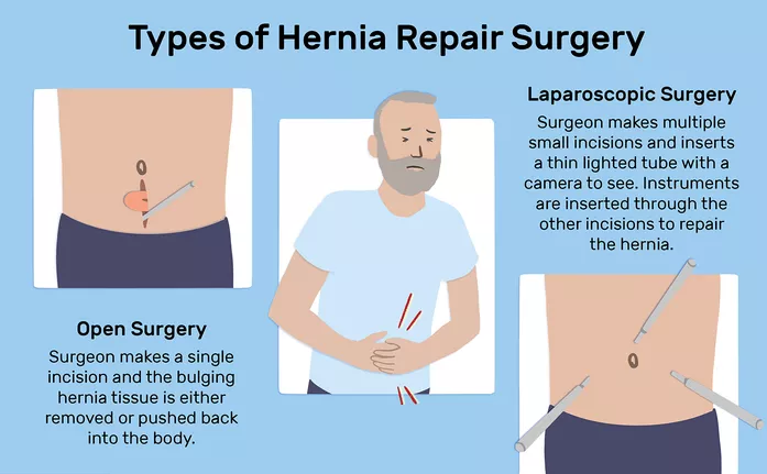 All About Hernia Surgery And Its Treatment Meril Life