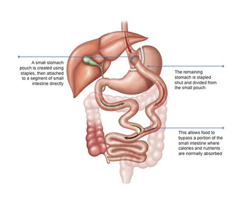 Gastric Bypass is a bariatric or weight loss surgery