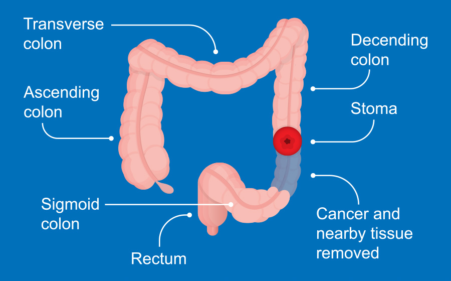 Details on Colon's Sections