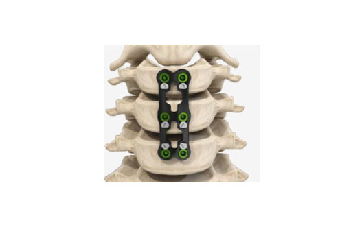 MERILOCK Spinal System for Fractures, Accidents and Trauma Cases